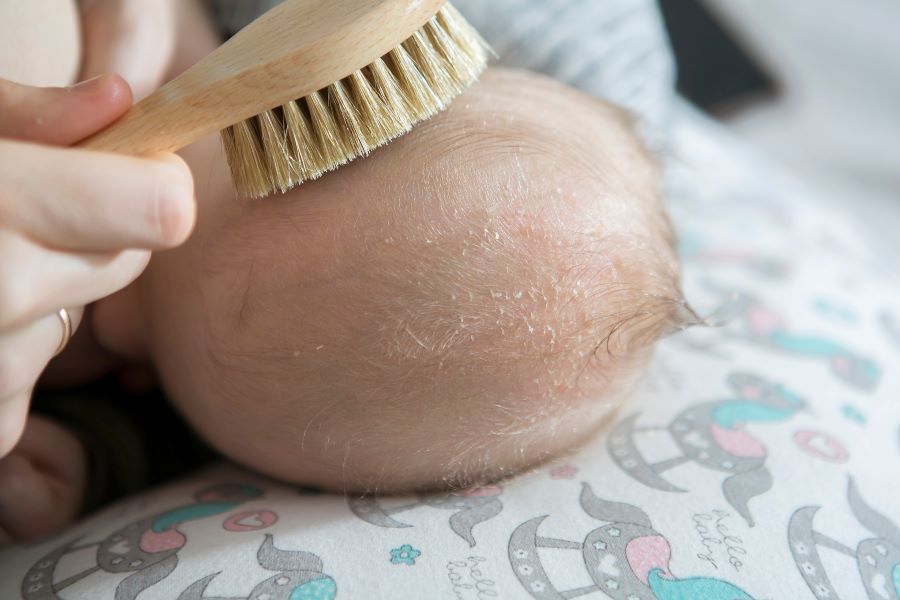 What is Cradle Cap image from Nabta Health